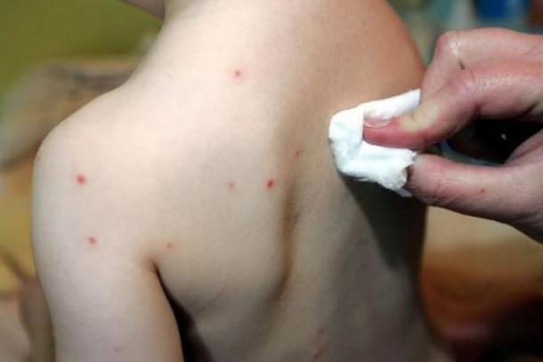 Alerte rouge à la varicelle dans l’Est de la France, la Lorraine très touchée